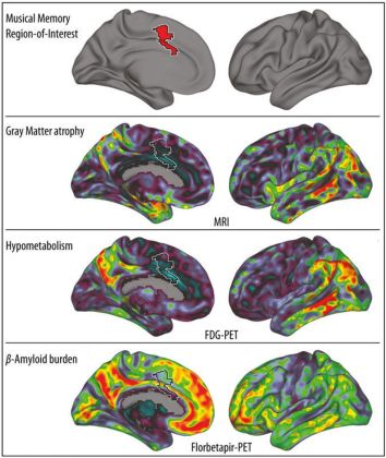 Foto: El gráfico muestra (en rojo, arriba) el giro cingulado anterior donde se almacenan los recuerdos musicales. Más abajo, visión bilateral de tres biomarcadores de Alzhéimer, en rojo las más afectadas / elpais.com
