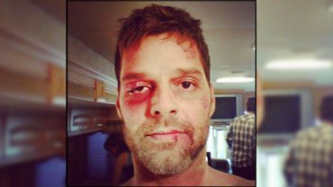 Impresionante foto de Ricky Martin golpeado