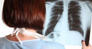 Nuevos tratamientos amplían las posibilidades de supervivencia ante el cáncer de pulmón