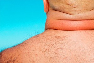 Cushing, un trastorno hormonal degenerativo confundido con obesidad
