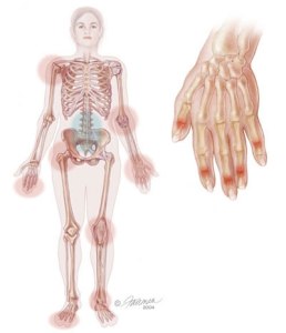 Artritis Psoriásica: Una enfermedad de la piel que afecta las articulaciones