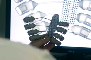 Impresión 3D y salud: Implantan la primera caja torácica impresa en 3D