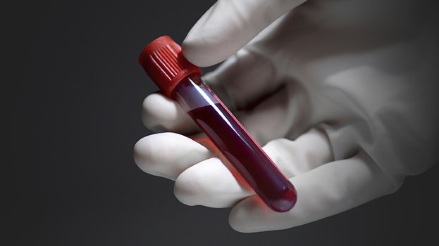 Desarrollan prueba sanguínea para la detección precoz del cáncer de colon