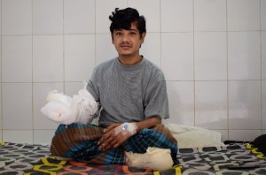 El “hombre-árbol” saldrá pronto del hospital tras 16 operaciones en Bangladés