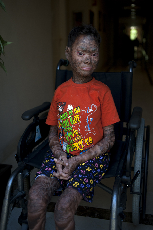 Shalini Yadav, 16, known as the "snake girl" poses in Marbella on September 15, 2017.  Shalini, who suffers recessive lamellar ichthyosis and sheds her skin every six weeks due to a rare condition, is to get life-improving treatment in southern Spain. / AFP PHOTO / JORGE GUERRERO