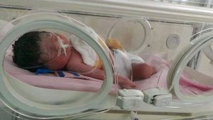 Operación a una bebé con el corazón expuesto en Bolivia “ha sido exitosa”
