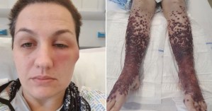 Las piernas de una mujer se llenaron con ampollas de sangre tras recibir la vacuna contra el Covid-19 (Imágenes sensibles)