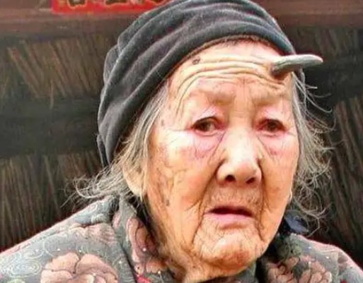 Zhang Ruifang, la mujer a la que le creció un cuerno de seis centímetros en la frente