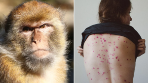 Lo que dicen los expertos sobre la viruela del mono