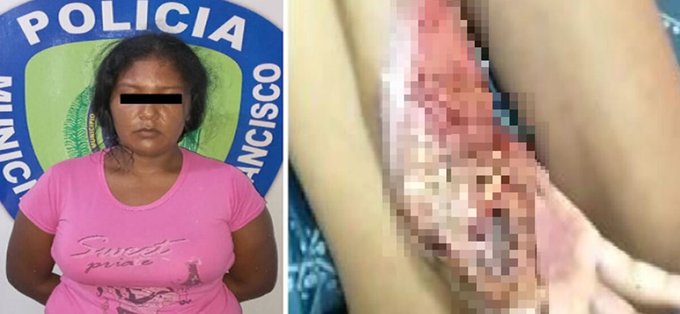 Horror en Zulia: Quemó la mano de su hija con la cocina hasta desprenderle un dedo