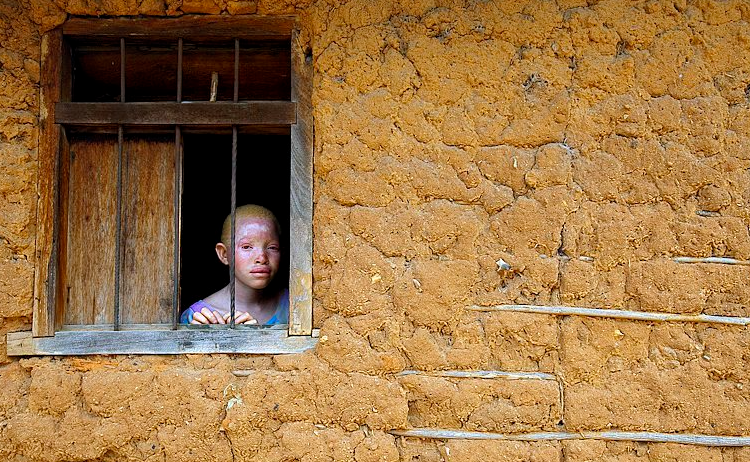 Una misteriosa ola de secuestros de personas albinas sacude Madagascar