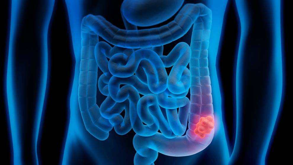 Nuevo fármaco evita efectos secundarios de quimioterapia en cáncer de colon