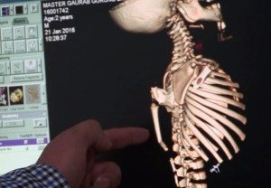 El extraño caso de un niño que tiene un tercer brazo en la espalda (VIDEO)