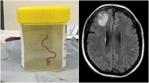 “Se movía felizmente”: El impactante relato de la cirujana que sacó un gusano vivo del cerebro de una paciente
