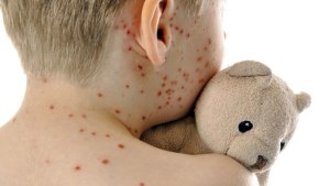 La OMS alerta de la subida “alarmante” de casos de sarampión en Europa